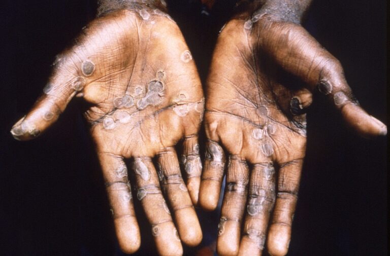 Il vaiolo delle scimmie (Monkeypox virus) preoccupa l’OMS
